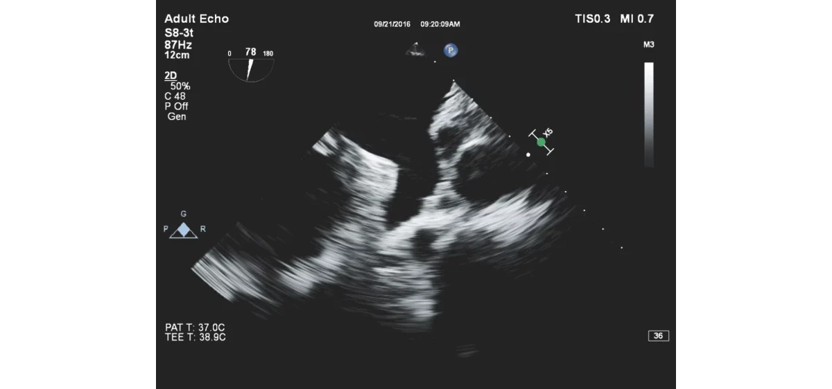 Описание и характеристики Philips EPIQ CVx ультразвуковой аппарат