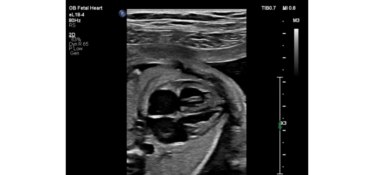 Описание и характеристики Philips EPIQ CVx ультразвуковой аппарат