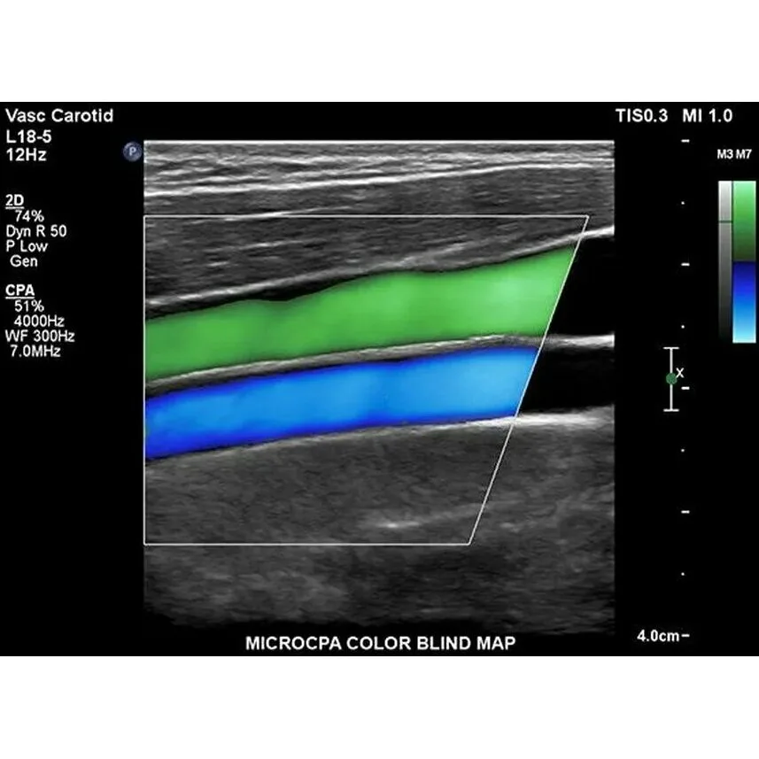 Philips EPIQ Elite ультразвуковой аппарат Philips EPIQ Elite ультразвуковой аппарат