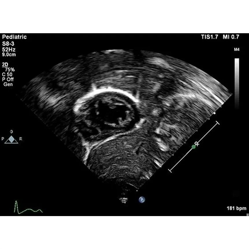 Philips EPIQ Elite ультразвуковой аппарат